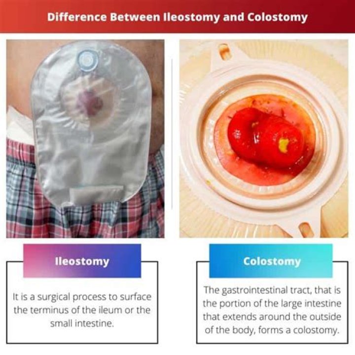 Ileostomy: A Comprehensive Guide to Understanding Kat Timpf's Journey