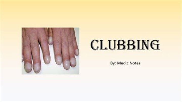 Understanding Clubitis Disease Symptoms: A Comprehensive Guide